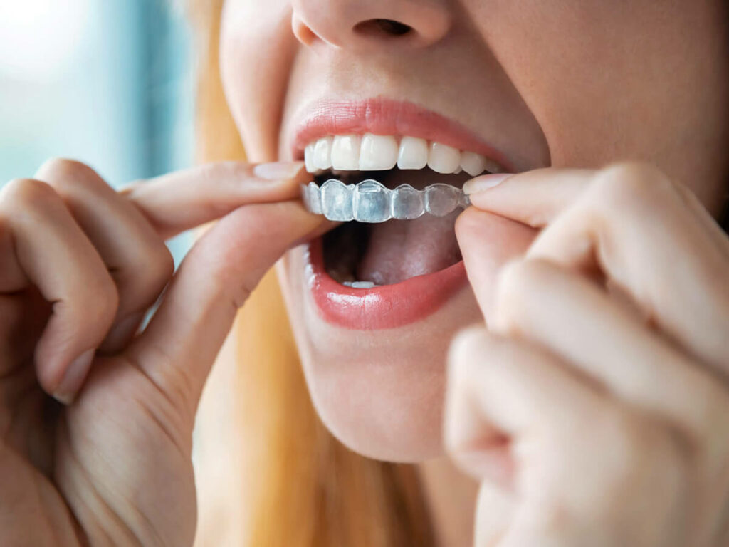 woman putting in an invisalign aligner