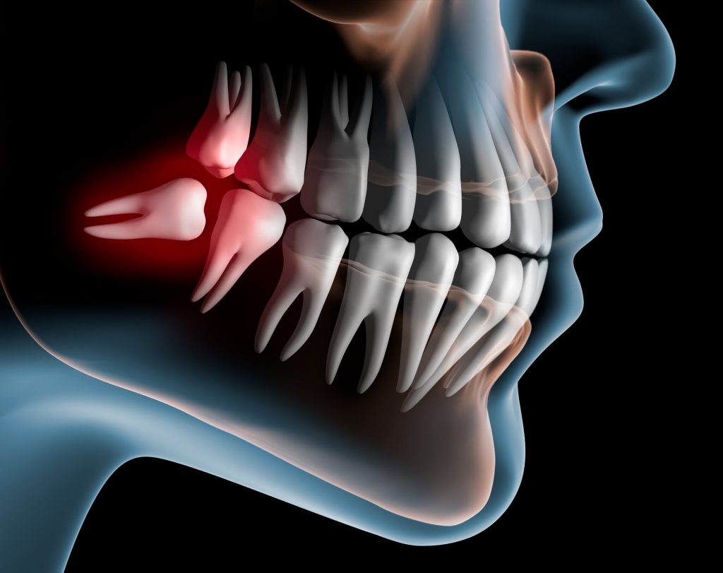 illustration of an impacted wisdom tooth