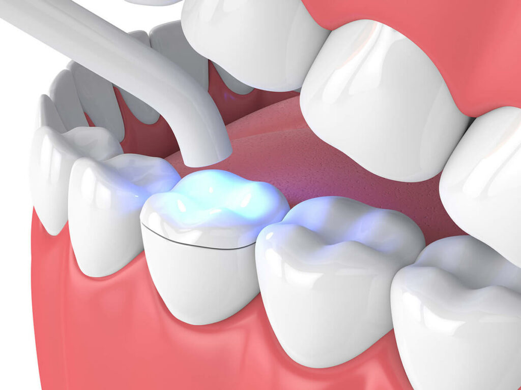 graphic of a dental onlay