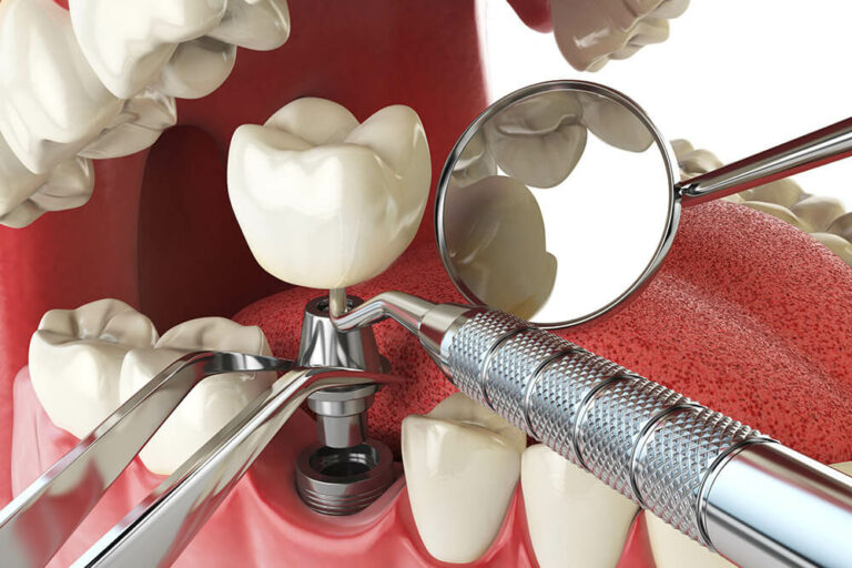 Graphic showing a dental implant being placed