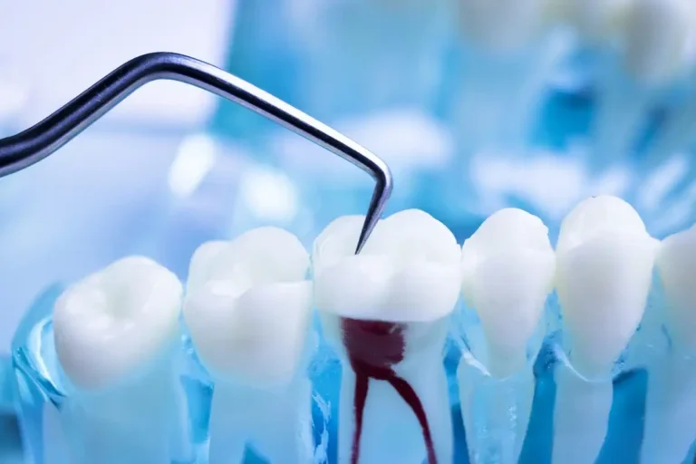 Dental model showing root canal treatment with metal tool.